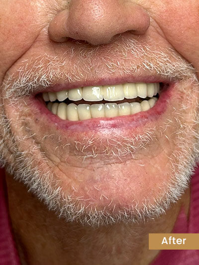 After tooth extraction - healthy healed socket ready for implant