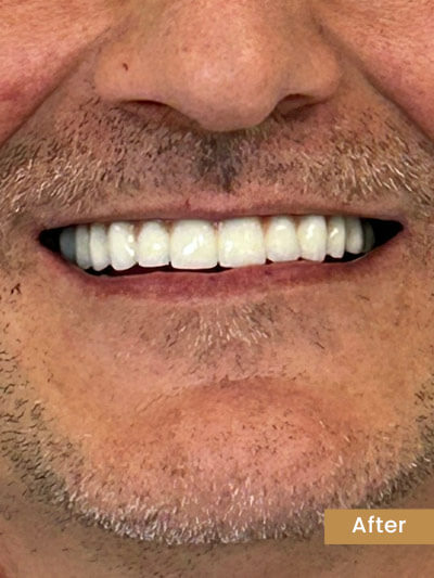 After Veneers - Patient smile after porcelain veneer treatment