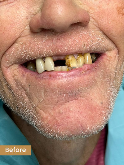 Before tooth extraction - damaged tooth requiring removal