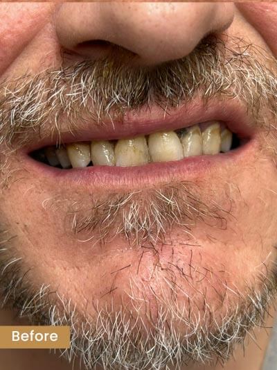Before Veneers - Patient smile before treatment